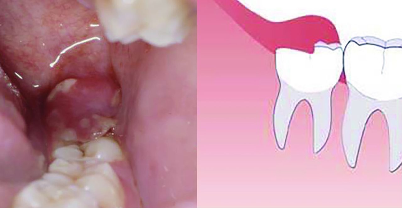 Pericoronitis