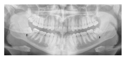 Wisdom teeth